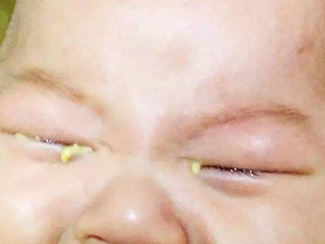 孩子老是有眼屎怎么回事