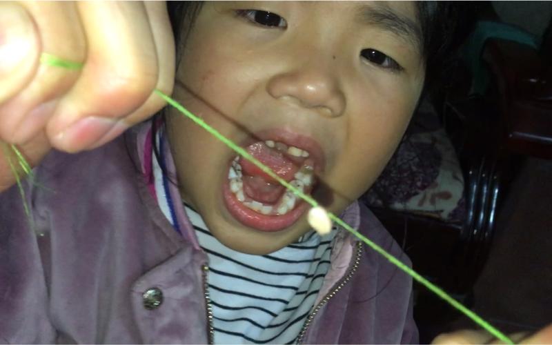 小孩子拔牙怎么拔