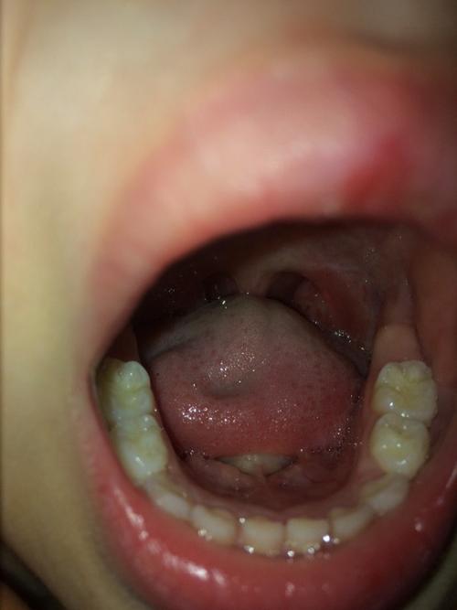 孩子经常扁桃体发炎怎么办