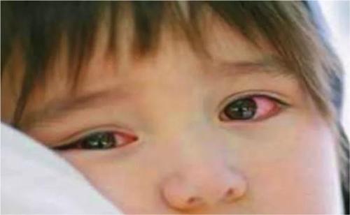 小孩子眼睛痒怎么办