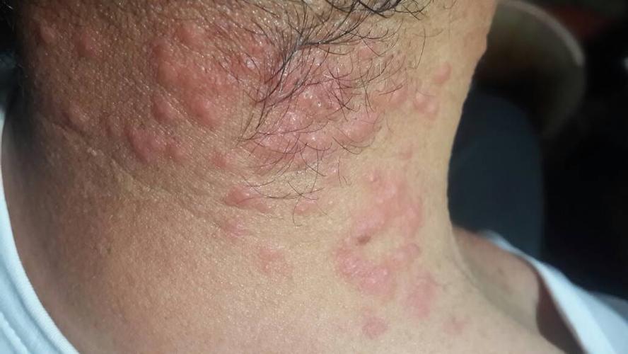 感觉脖子肿胀 吃东西咬起困难