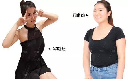 节食加运动成功案例