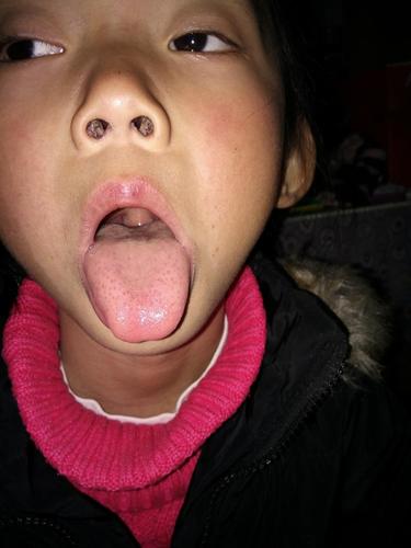 孩子喉咙发炎发烧怎么办