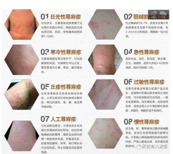 孩子荨麻疹怎么办