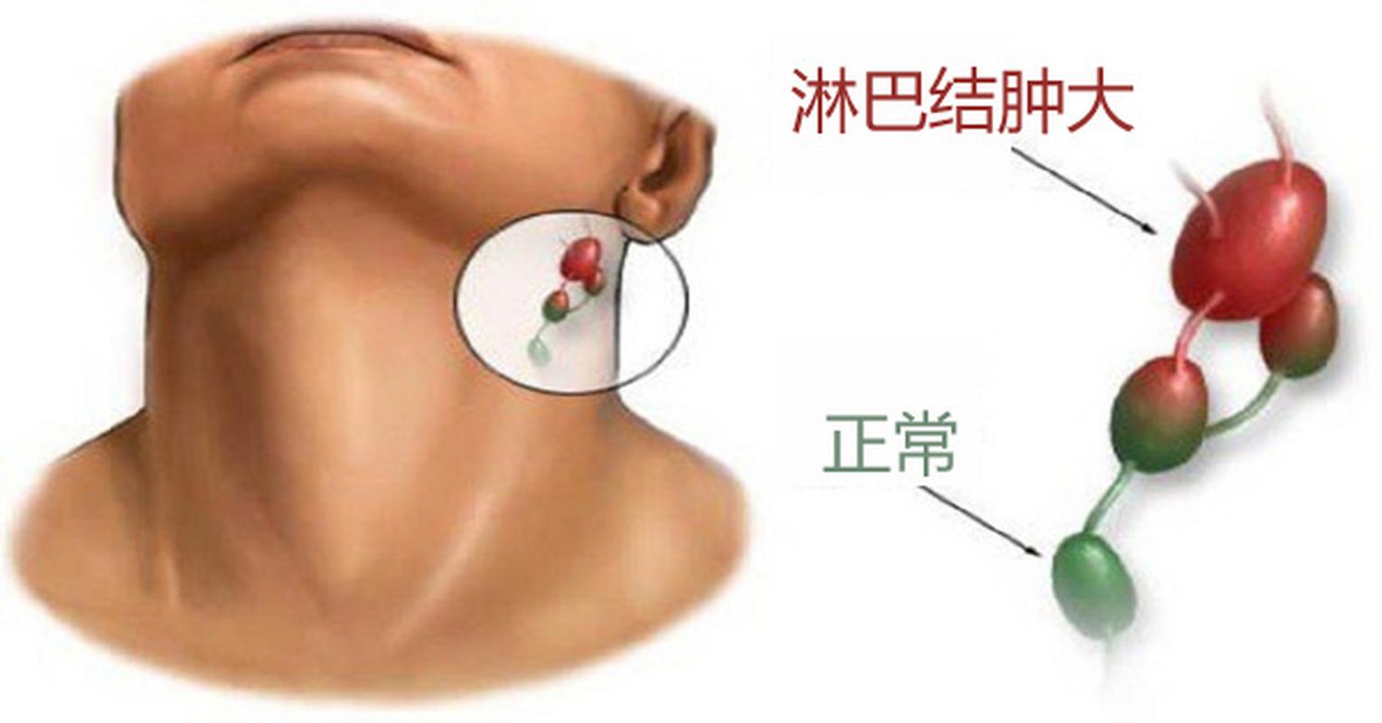 孩子淋巴结肿大怎么办