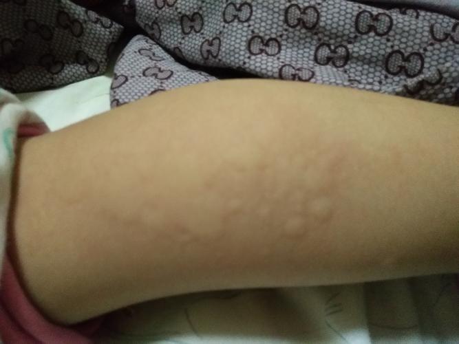 孩子起风疹怎么办