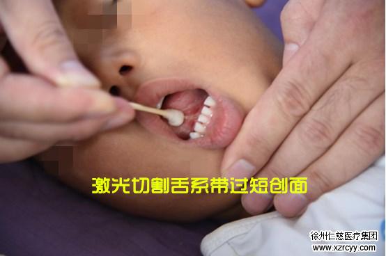 孩子大舌头怎么办