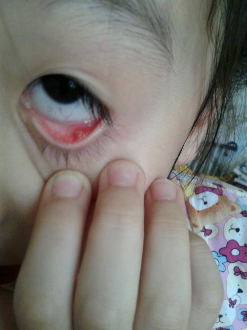 小孩子眼睛长麦粒肿怎么办