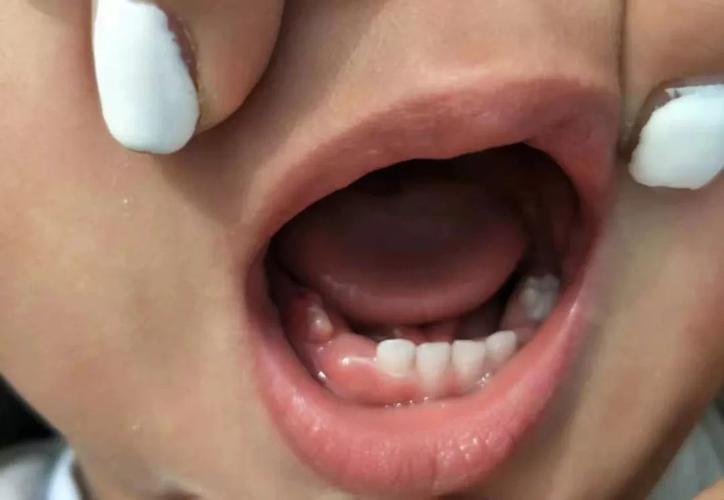 小孩子牙龈红肿怎么办