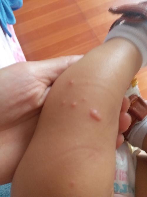 孩子身上长水痘怎么办