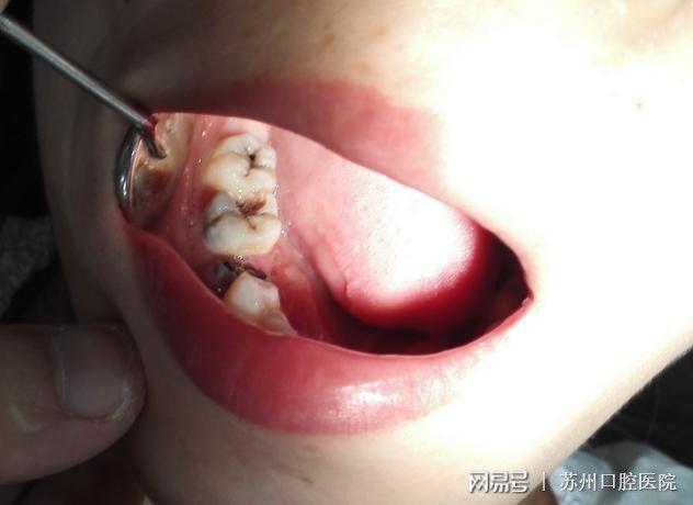 5岁孩子有蛀牙怎么办