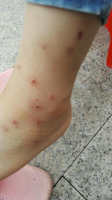 孩子皮肤过敏怎么办