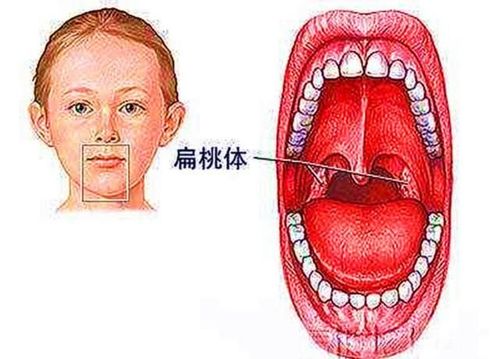 孩子扁桃体反复发炎怎么办
