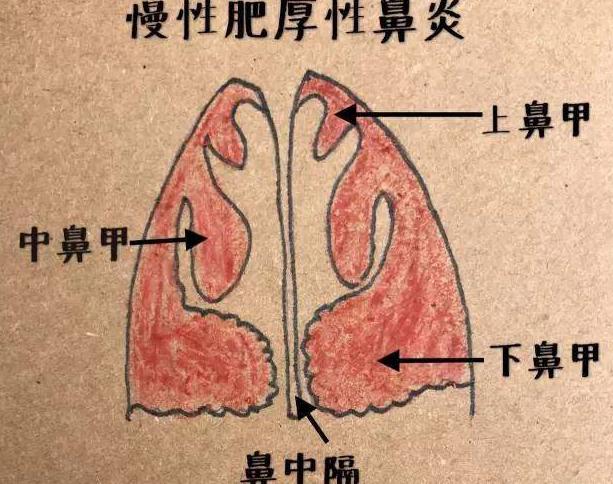 孩子鼻甲肿大怎么办