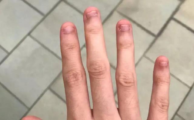 孩子啃手指甲怎么办