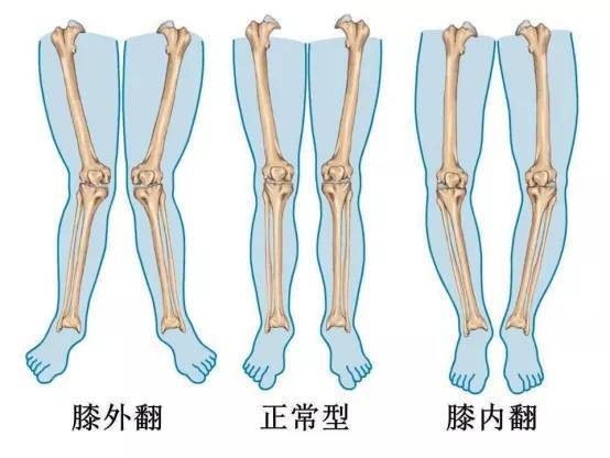 孩子的腿不直怎么办