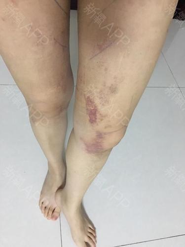运动洗完澡大腿肿胀