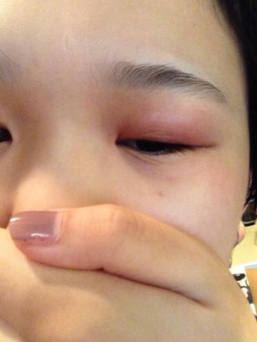 孩子眼睛麦粒肿怎么办