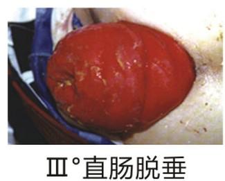 小孩子脱肛怎么办