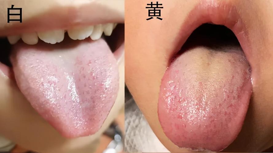孩子舌苔白怎么办