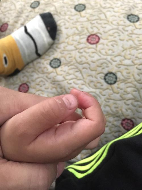 孩子指甲凹凸不平怎么回事
