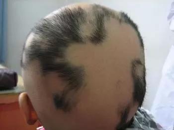 孩子掉头发怎么回事