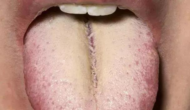 孩子舌苔白厚怎么调理