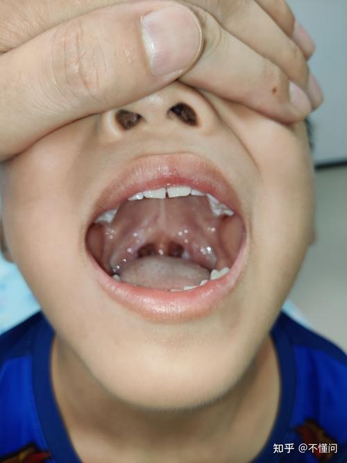 小孩子扁桃体肥大怎么办