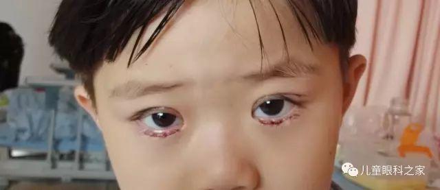 孩子倒睫毛怎么办