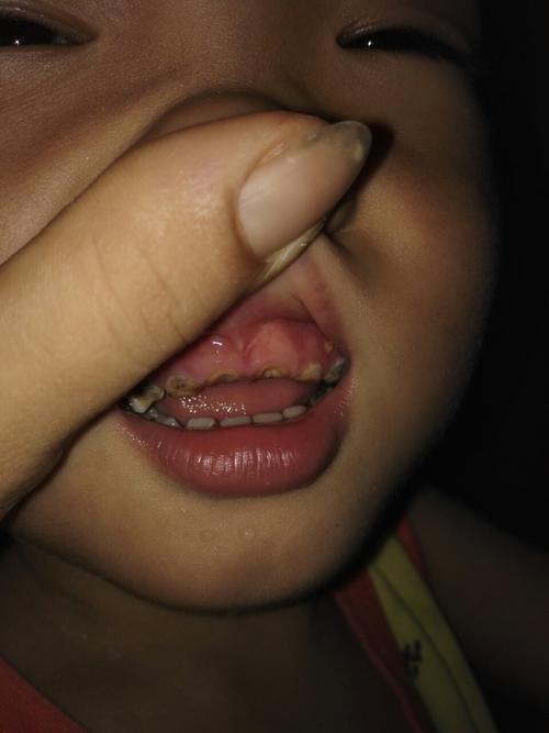 三岁孩子牙齿烂了怎么办