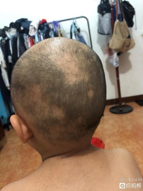 7岁孩子掉头发怎么回事