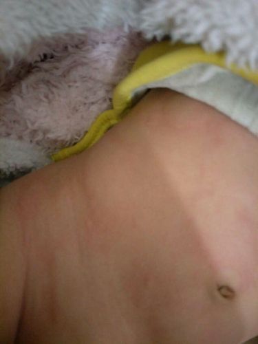 小孩子身上痒怎么办