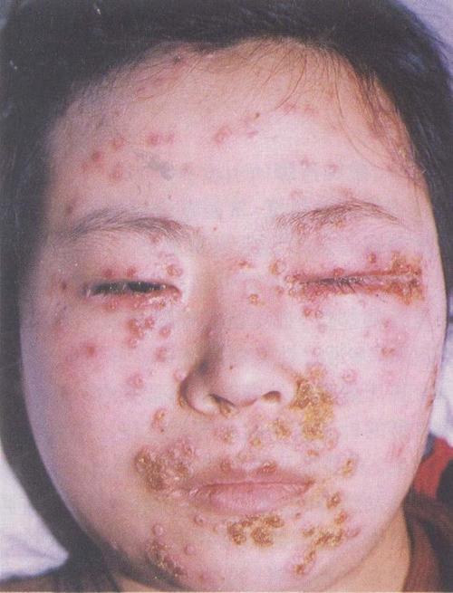 孩子出水痘怎么办