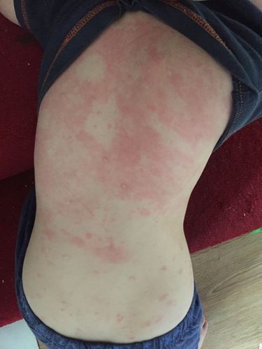 孩子身上过敏怎么办