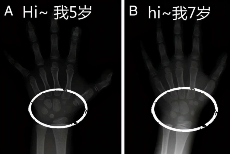 孩子骨龄偏大怎么办