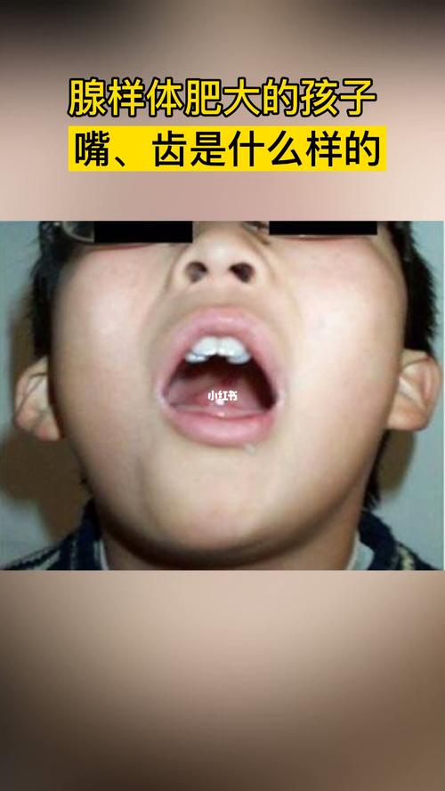 小孩子腺样体肥大怎么办