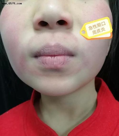孩子嘴角烂怎么办
