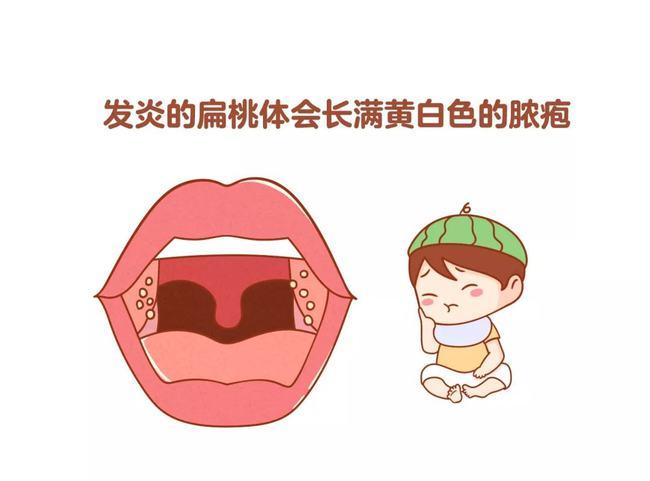 孩子扁桃体化脓怎么办