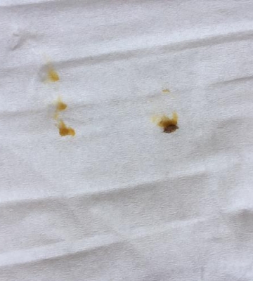 孩子耳朵里有硬耳屎怎么办