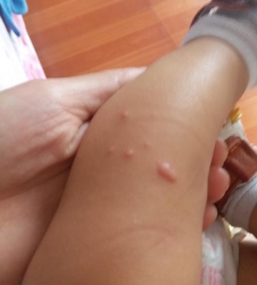 孩子身上长水痘怎么办