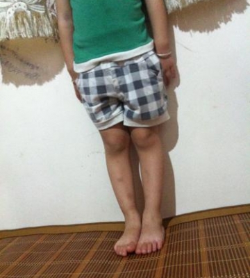 孩子罗圈腿怎么矫正