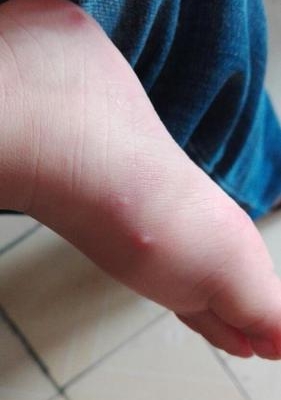 孩子起水痘了怎么办