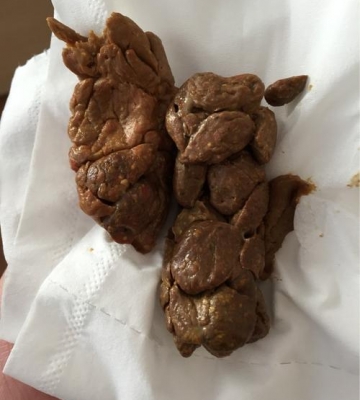 两三天不大便吃的东西哪去了
