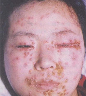 孩子出水痘怎么办