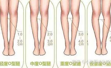 小孩子罗圈腿怎么矫正