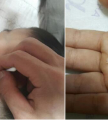 小孩子耳屎很多怎么办