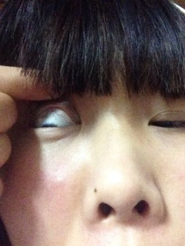 白眼球上有白色的东西怎么治疗