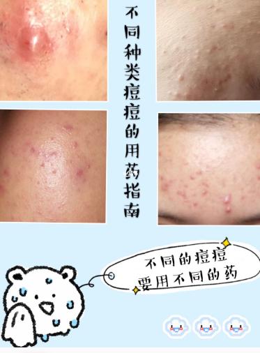 如何缓解痤疮