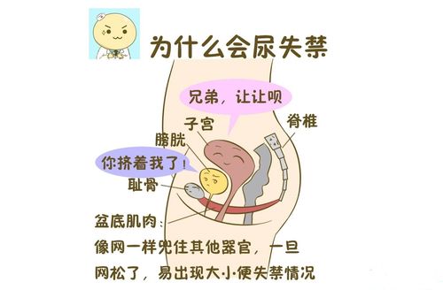 如何预防尿失禁