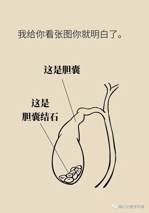 如何避免胆囊疾病